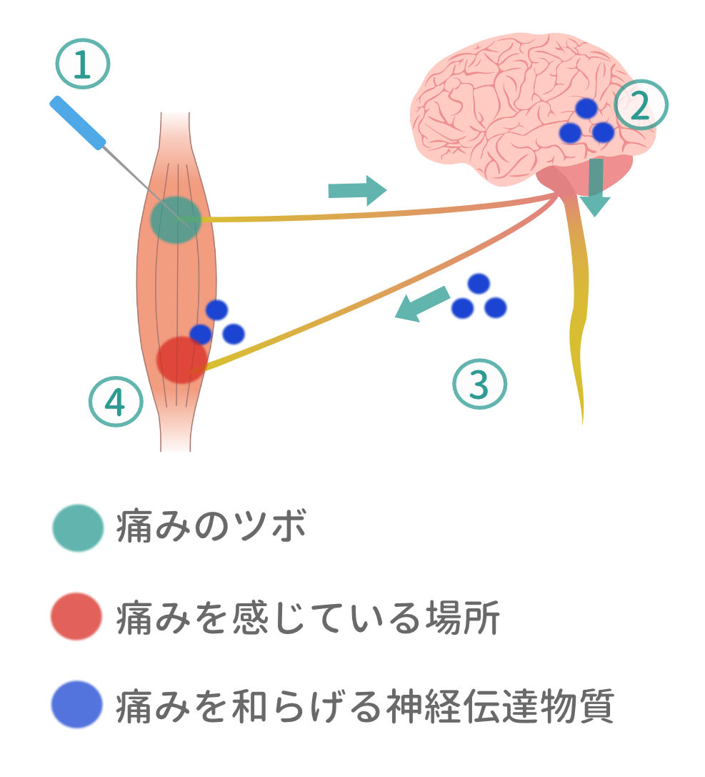 筋肉の痛みのツボへの刺激が脳に伝わり痛みを和らげる物質が作用する図